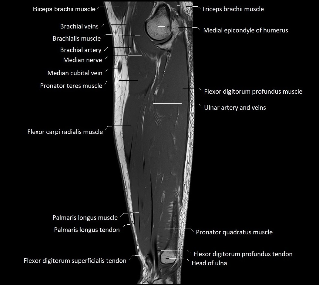 MRI 3T forearm sagittal labelled cross sectional anatomy image 27.webp